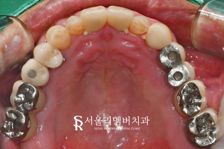 임플란트 및 크라운 으로 구강 환경 개선하는 방법 - 서울대입구역 치과 관련 이미지 6