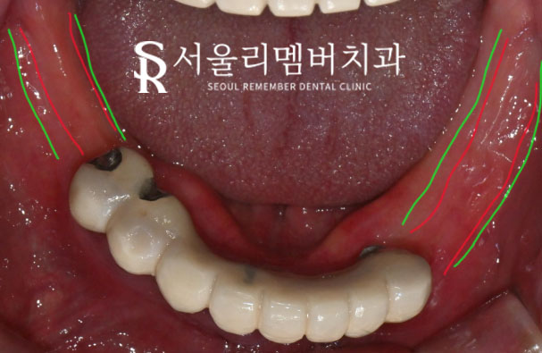 서울대입구역 치과 , 잇몸뼈 부족해도 전체 임플란트 ? 가능합니다. <증례 有> 관련 이미지 2