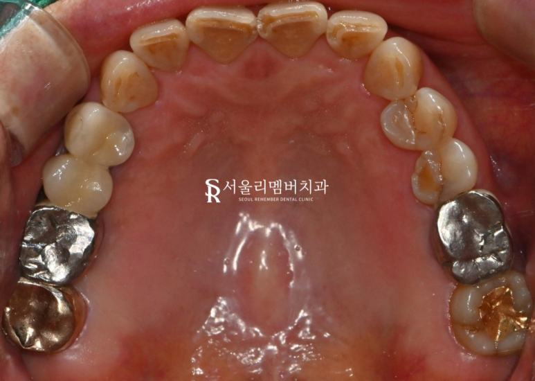 서울대입구역 치과 음식 찌꺼기가 계속 껴요. 관련 이미지 6