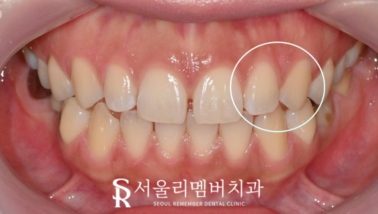 투스잼(tooth gem) 그냥 떼면 큰일난다? 상도동 치과 앞니 치아 손상 없이 레진 제거하는 방법 관련 이미지 2