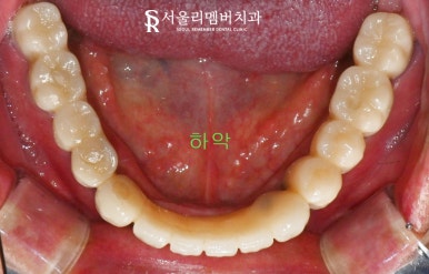 임플란트로 구강환경개선 신림역 치과 에서 깔끔하게 치료한 케이스 관련 이미지 5