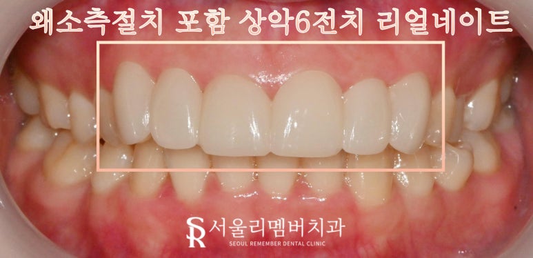봉천동 치과 작은 앞니 왜소치 최소 삭제 및 통증 손상 없는 리얼 라미네이트 (Laminate)로 6전치 보철 수복 치료 관련 이미지 4