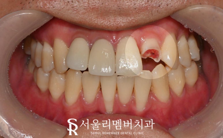 서울대입구 치과 앞니 심한 파절 및 신경치료 + 포스트 코어 + 지르코니아 심미 보철 크라운 진료 과정 관련 이미지 1