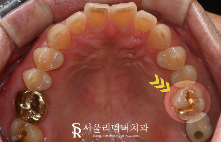 골드인레이 어금니 크랙이 있다면 신림역 치과 발치 즉시 임플란트 관련 이미지 1