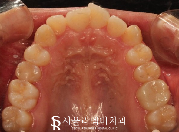서울대입구역 치과 툭 튀어나온 돌출 때문에 발치교정 진행 관련 이미지 2
