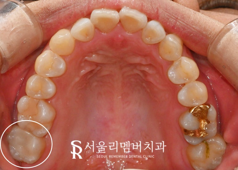 봉천동 치과 인레이 했던 치아가 깨졌다면? 스트라우만 나이스 인레이 재치료 관련 이미지 3