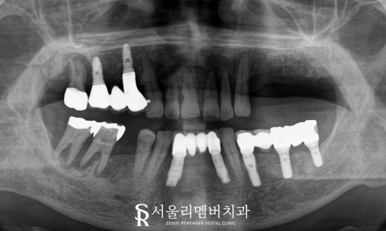 서울대입구역 치과 에서 최소 비용으로 다수 임플란트 브릿지 크라운 진행한 케이스 관련 이미지 2