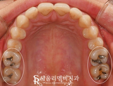 오래된 아말감 신림 치과 수면(의식하 진정) 마취 후 스트라우만 나이스 인레이로 교체 (좌우 2회로 나누어 진행 가능) 관련 이미지 2