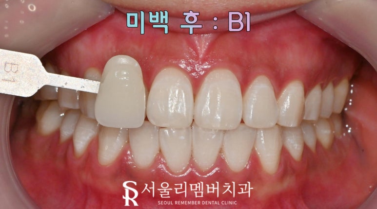 봉천동 치과 의사가 알려주는 치아미백 방법, 효능, 원리, 주의 사항 관련 이미지 4