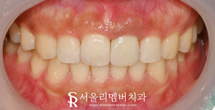 Sillim Dental Clinic: Crowded Front Teeth That Shifted Again and an Old PFM Crown, Zirconia Esthetic Prosthetic Treatment After Re-orthodontic Correction image 4