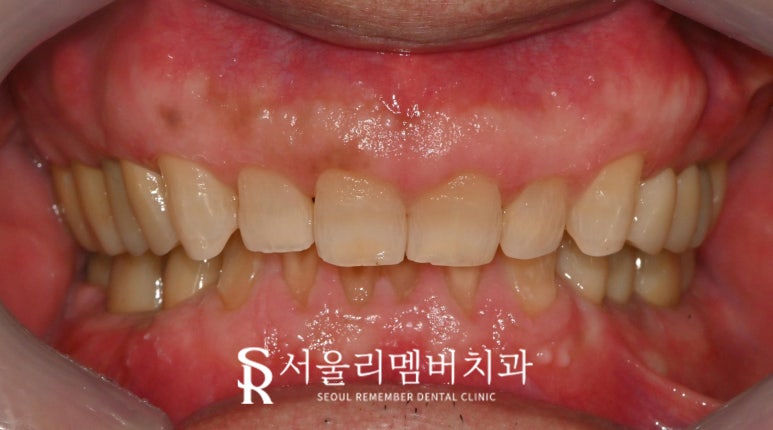 서울대입구역 치과 어금니 상실로 무너진 수직 고경과 과개 교합, 신경치료 크라운과 임플란트로 개선할 수 있다면 관련 이미지 7