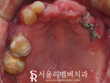 여러 곳이 결손된 치아 서울대입구역 치과 에서 다수 임플란트 식립으로 불편감을 개선해 드린 케이스 관련 이미지 1