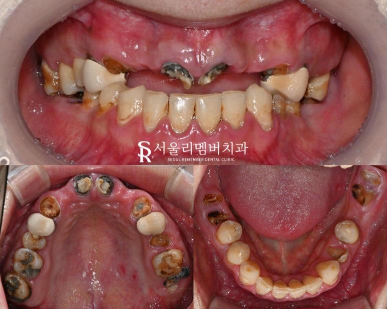 믿고 맡길 수 있는 신대방 치과 전체 임플란트 관련 이미지 2
