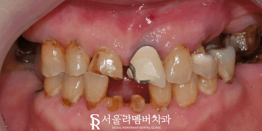 서울대입구역 치과 에서 수면(의식하진정)요법 동반한 전체 임플란트 식립 관련 이미지 9