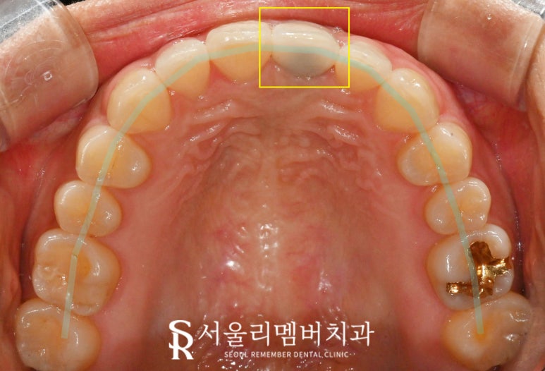 Sillim Dental Clinic: Crowded Front Teeth That Shifted Again and an Old PFM Crown, Zirconia Esthetic Prosthetic Treatment After Re-orthodontic Correction image 3