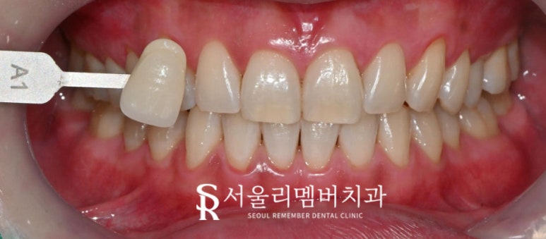 "변색 원인, 미백 방법, 주의사항까지" 서울대입구역 치과 에서 알려주는 하얀 치아를 위한 모든 것 관련 이미지 5