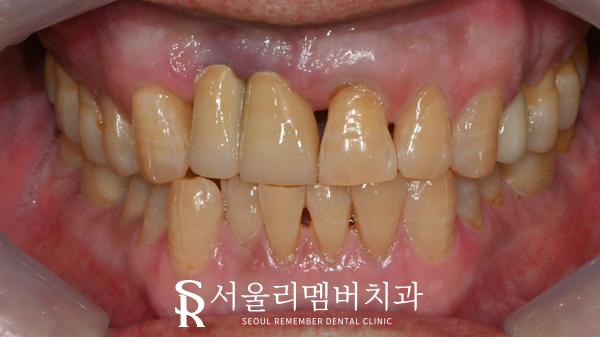 앞니 빠짐, 서울대입구역치과 심미보철로 개선을 도와드렸습니다. 관련 이미지 2