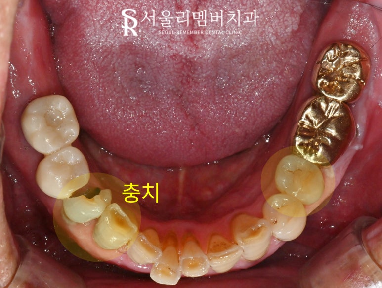 사당역 치과 충치, 치아 흔들림, 파절, 결손, 염증.. 다수의 복합 문제 생겼다면 임플란트 신경치료 크라운 과정 관련 이미지 3