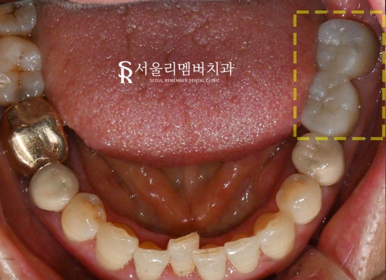 살리려던 어금니, 신경치료 시도 후 결국 임플란트로 복구한 보라매 치과 치료 사례 관련 이미지 6