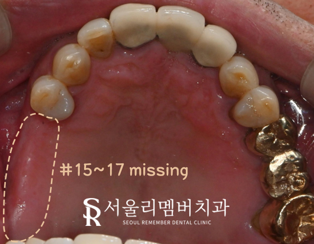 봉천동 치과 임플란트 치료 과정, 어금니가 없어서 식사가 어려워요. 관련 이미지 1