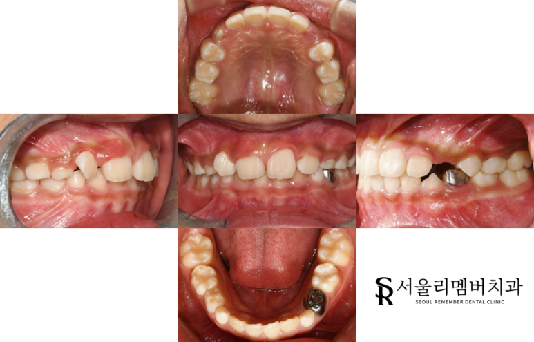 과개교합 전 관련 이미지 1