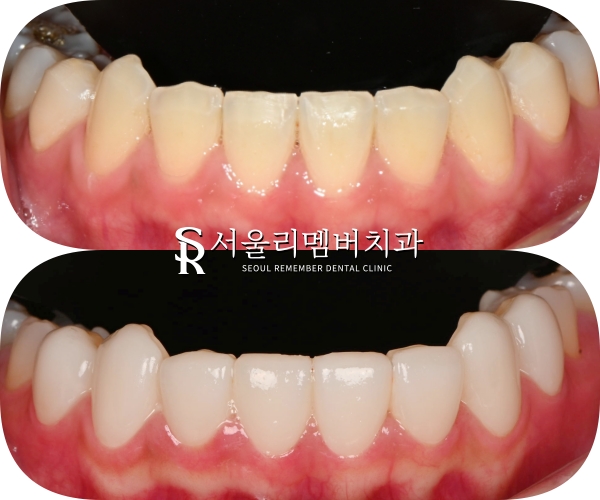사당역 치과 리얼네이트 심미보철 라미네이트로 누렇고 약한 앞니부터 작은 어금니까지 변화 관련 이미지 9