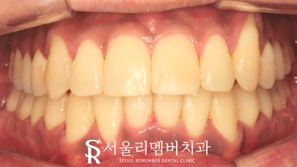 서울대입구역 치과 에서 들쑥날쑥 했던 치열, 비발치로 개선해 드렸습니다. 관련 이미지 7