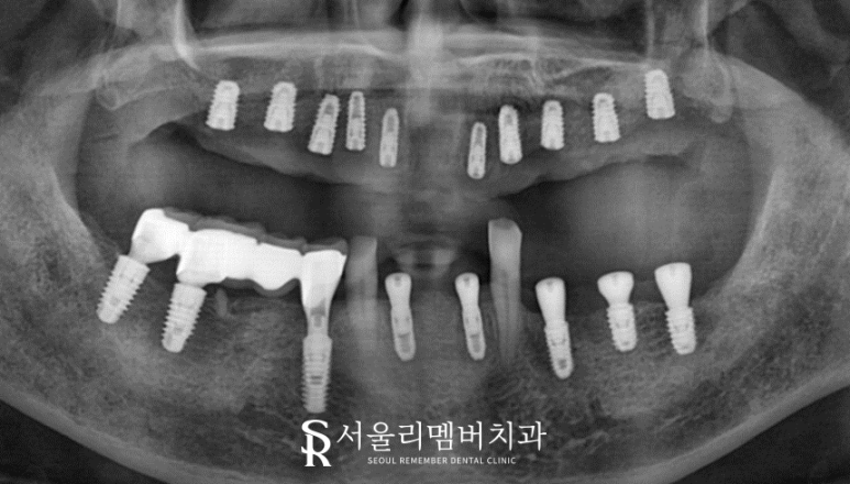 전에 씌워놨던 크라운에서 통증이 느껴져요.. 도대체 왜 그런 거죠? 서울대입구역 서울 리멤버 치과 관련 이미지 5