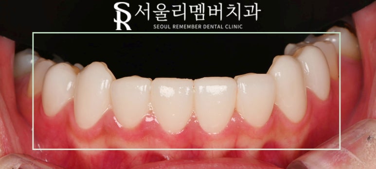 사당역 치과 리얼네이트 심미보철 라미네이트로 누렇고 약한 앞니부터 작은 어금니까지 변화 관련 이미지 7