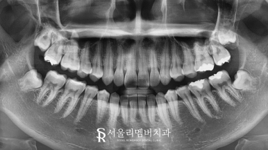 서울대입구역치과 "교정할 때 이를 꼭 뽑아야 되나요?" 돌출입 비발치 개선 관련 이미지 3
