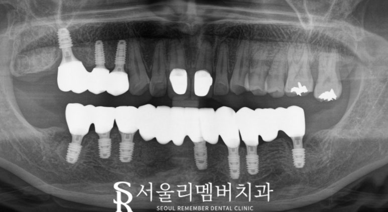 "잇몸에 고름이 차고 흔들려요!" 서울대입구 임플란트 디지털 진료로 치료한 사례 관련 이미지 5