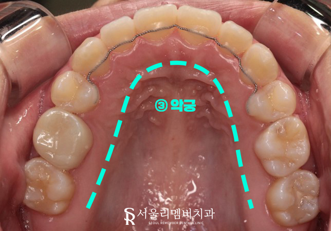 서울대입구역 치과 툭 튀어나온 돌출 때문에 발치교정 진행 관련 이미지 13