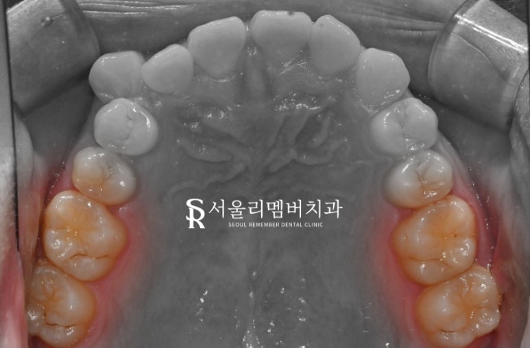어금니에 까만 점이 있어요.. 충치치료를 받아야 되나요? 봉천역 치과 관련 이미지 1