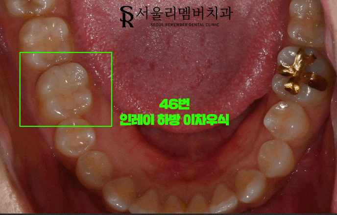 이차우식(secondary caries)이 생겼다면 어떻게 치료를 해야 될까? 서울대입구역 치과 관련 이미지 2