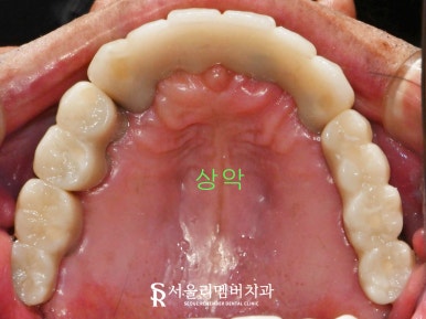 임플란트로 구강환경개선 신림역 치과 에서 깔끔하게 치료한 케이스 관련 이미지 6