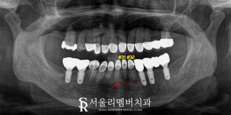 앞니 치아 뿌리 염증 당일 임플란트 하고 싶다면 신대방역 치과 관련 이미지 1