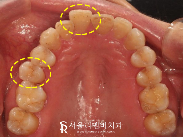 40대 교정 지금 시작해도 늦지 않을까요? 서울대입구역 치과 관련 이미지 2