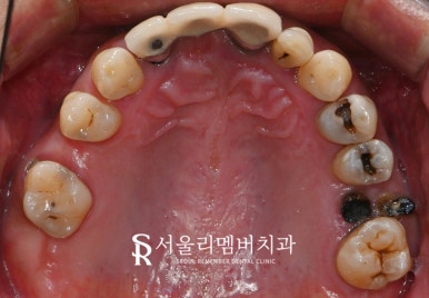 한 번에 많은 치아 치료해야 된다면? 사당역 치과 수면 임플란트 로 편안하게 관련 이미지 2