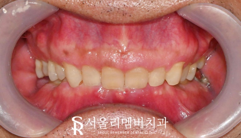 서울대입구역 치과 어금니 상실로 무너진 수직 고경과 과개 교합, 신경치료 크라운과 임플란트로 개선할 수 있다면 관련 이미지 4