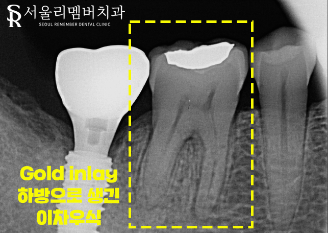낙성대역 치과 신경치료가 필요한 경우는?! 관련 이미지 4