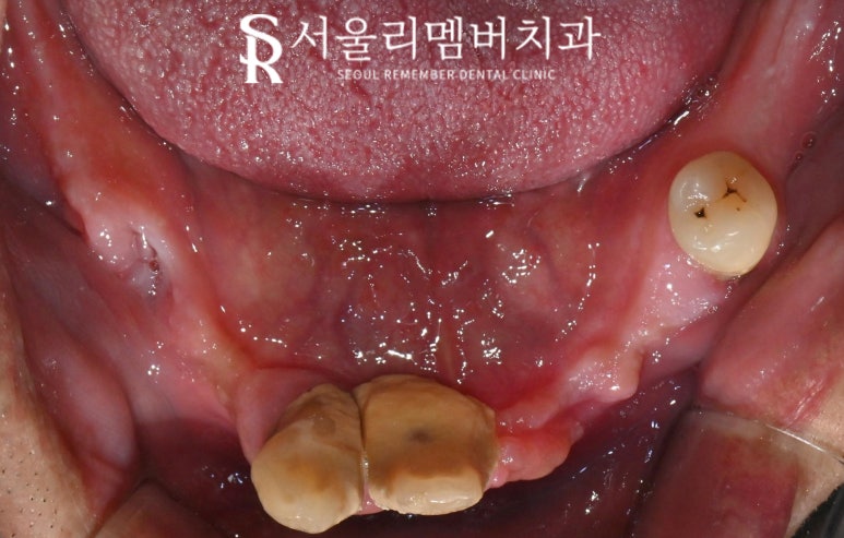 신대방 치과 에서 전악 수면마취 임플란트 수술로 전체 치아 회복시켜드렸습니다. 관련 이미지 4