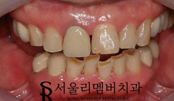 사당동 서울 리멤버 치과 "앞니가 깨졌는데 바로 진료 받을 수 있을까요..?" 관련 이미지 1