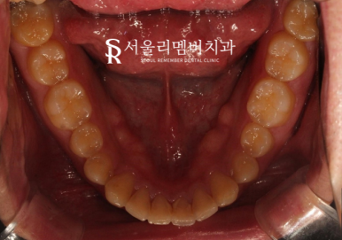 과개교합, 외적인 문제는 물론이며 기능 회복까지 개선하는 것이 중요합니다. 신대방치과 치아교정 관련 이미지 5
