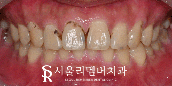 앞니 충치, 서울대입구역 치과 에서 당일 레진 치료로 빠르게 환한 웃음 되찾으세요! 관련 이미지 4