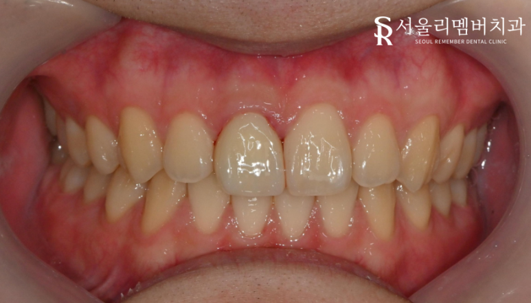 전치부 신경치료 과정과 주의사항은? (post&core) 영등포동 치과 관련 이미지 6