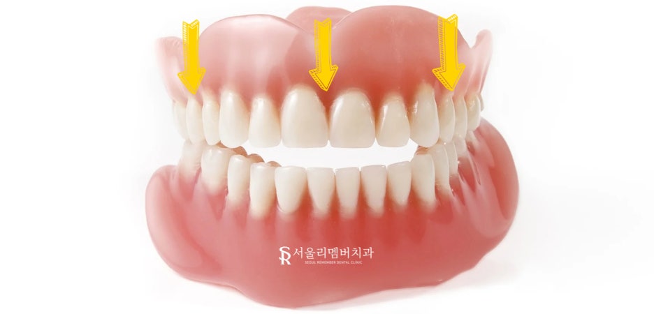 서울대입구역 치과 나에게 맞는 보철은 틀니? 임플란트? 관련 이미지 4