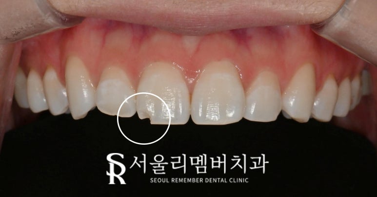 사당 치과 앞니 살짝 깨짐 절단연 파절, 당일 레진 충전으로 심미성 회복 관련 이미지 1