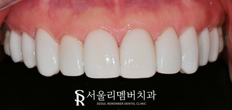 앞니 탈회 초기 충치 절단연 깨짐 치아 길이 안맞음 서울대입구 치과 전치부 리얼네이트 치료 과정 관련 이미지 5