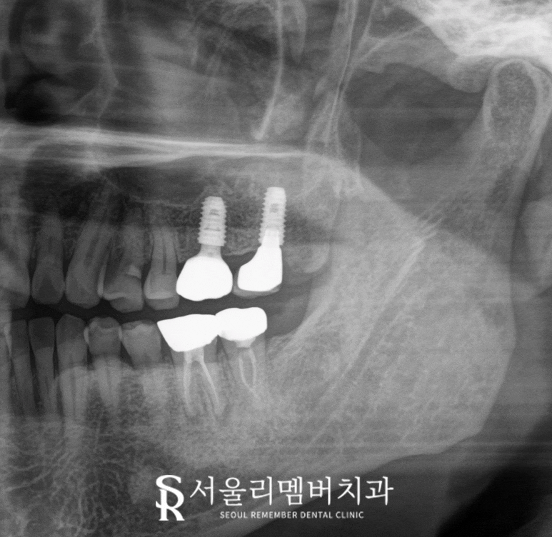 골드인레이 어금니 크랙이 있다면 신림역 치과 발치 즉시 임플란트 관련 이미지 4