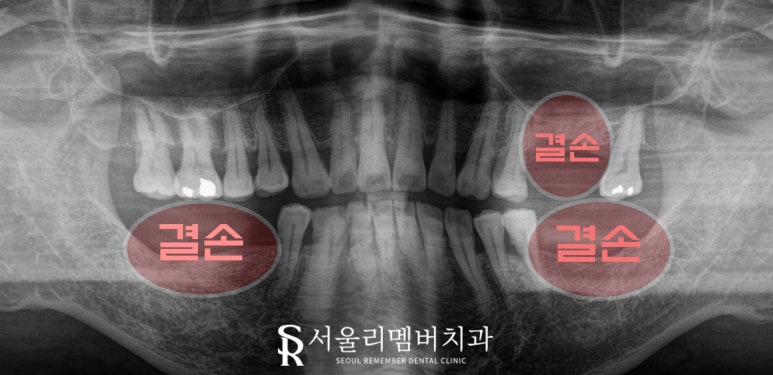 해외 거주하는 한국인, 임플란트 치료는 국내에서 받고 싶다면? 상도동 치과 수술 계획 및 과정 관련 이미지 4